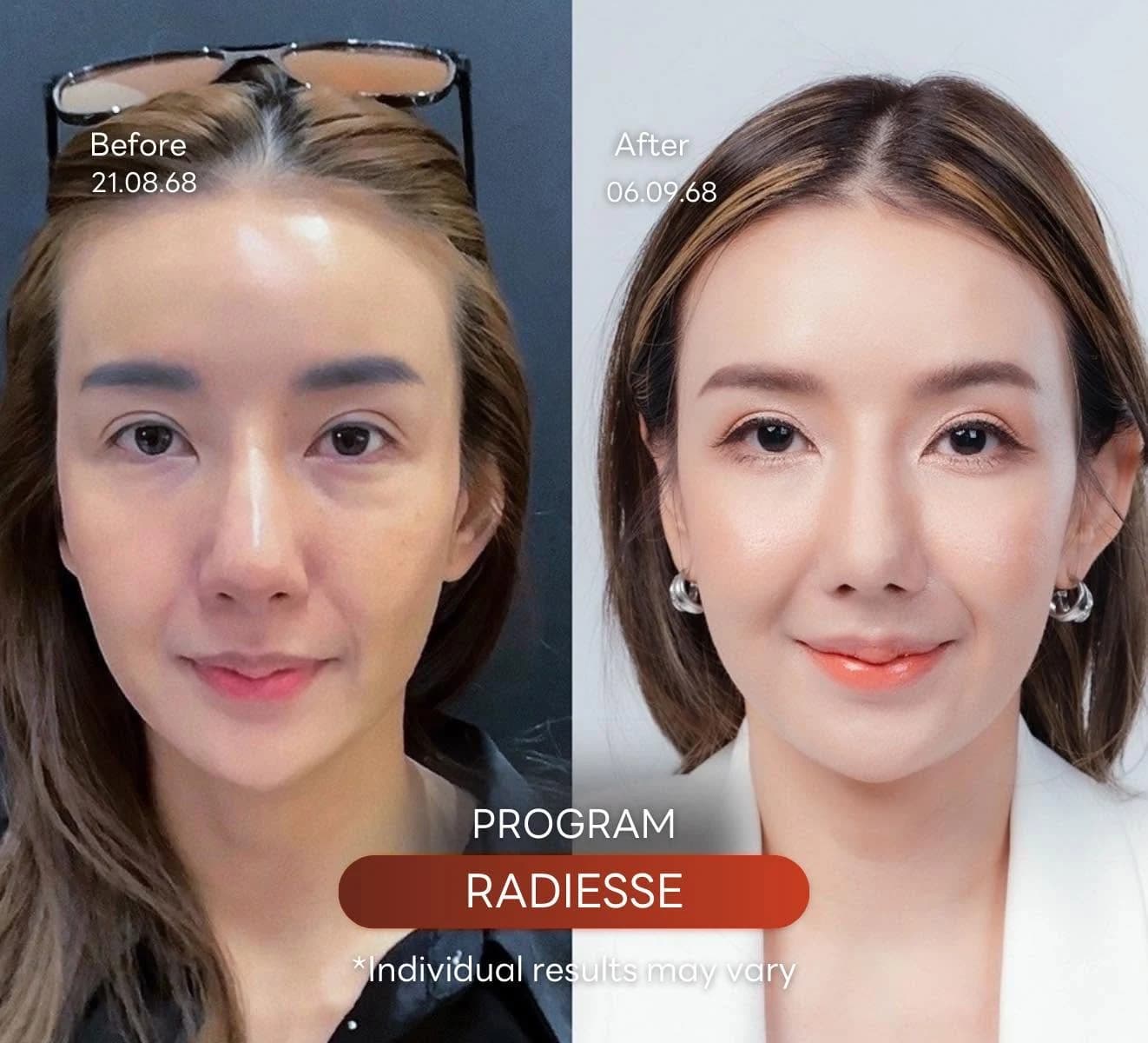 Radiesse — CaHA Microsphere Biostimulator Program ที่ Waleerat Clinic Bangkok