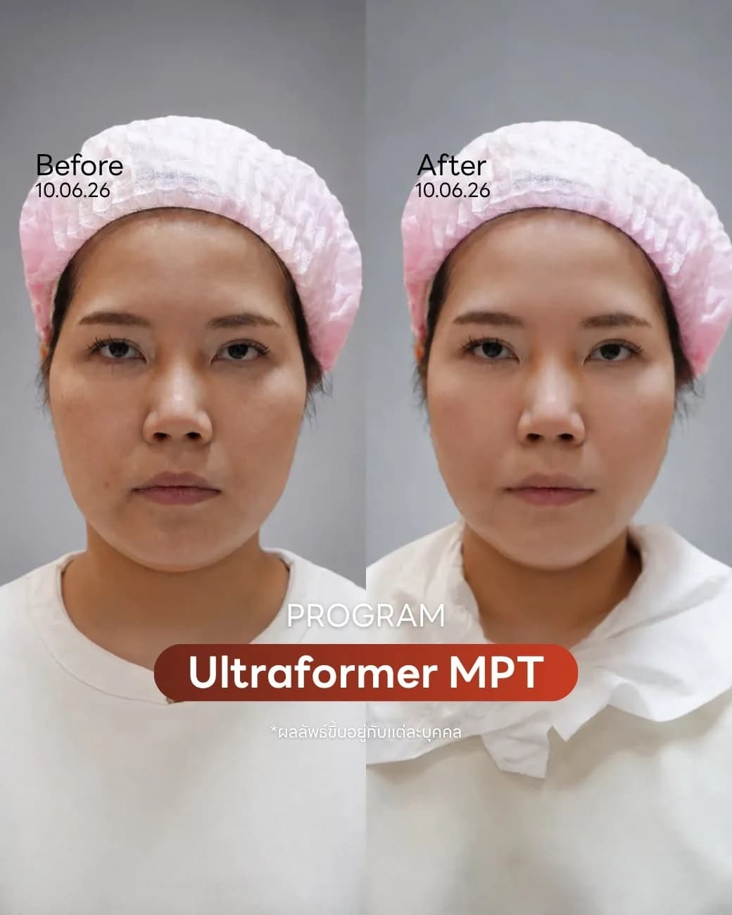 Ultraformer MPT — Micro Pulsed HIFU Lifting Program