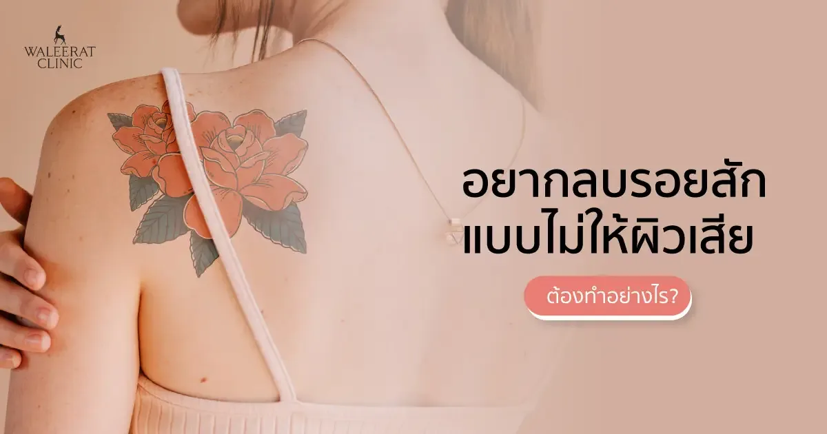 Pico Laser ลบรอยสัก ด้วยเทคโนโลยีระดับสูง