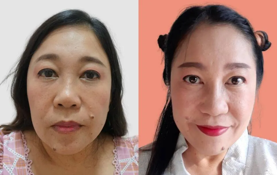 Botox before and after — wrinkles, crow's feet, square jaw — real patient result at Waleerat Clinic Bangkok (Siam & Ekamai)