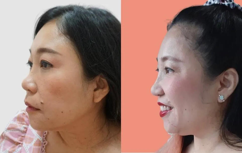 Botox before and after — wrinkles, crow's feet, square jaw — real patient result at Waleerat Clinic Bangkok (Siam & Ekamai)