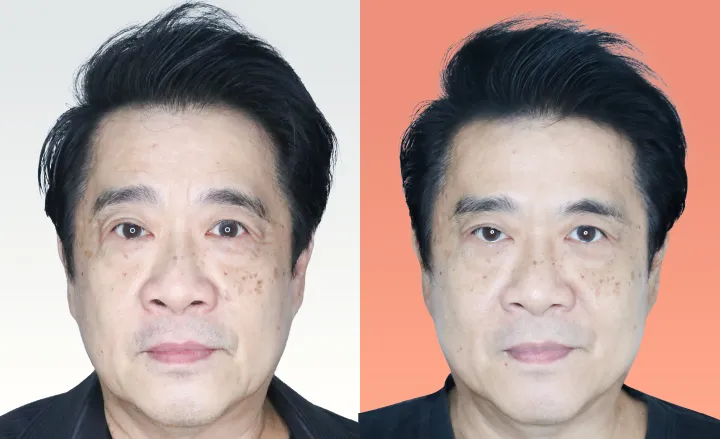 Botox before and after — wrinkles, crow's feet, square jaw — real patient result at Waleerat Clinic Bangkok (Siam & Ekamai)