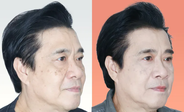 Botox before and after — wrinkles, crow's feet, square jaw — real patient result at Waleerat Clinic Bangkok (Siam & Ekamai)