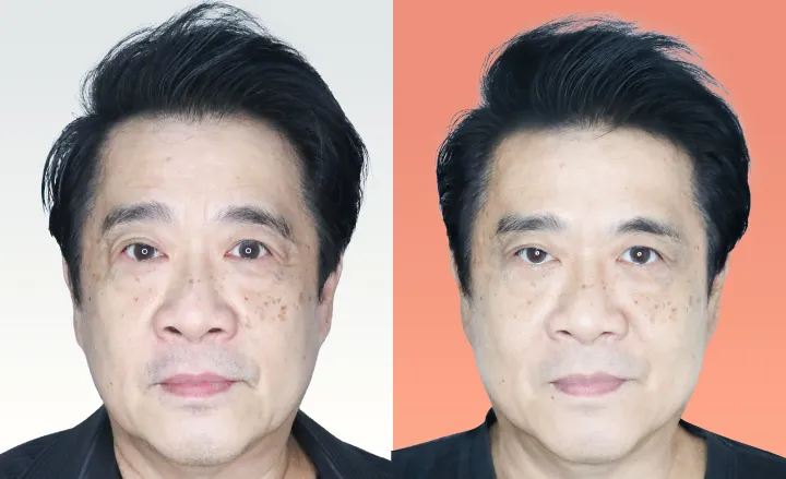Botox before and after — wrinkles, crow's feet, square jaw — real patient result at Waleerat Clinic Bangkok (Siam & Ekamai)