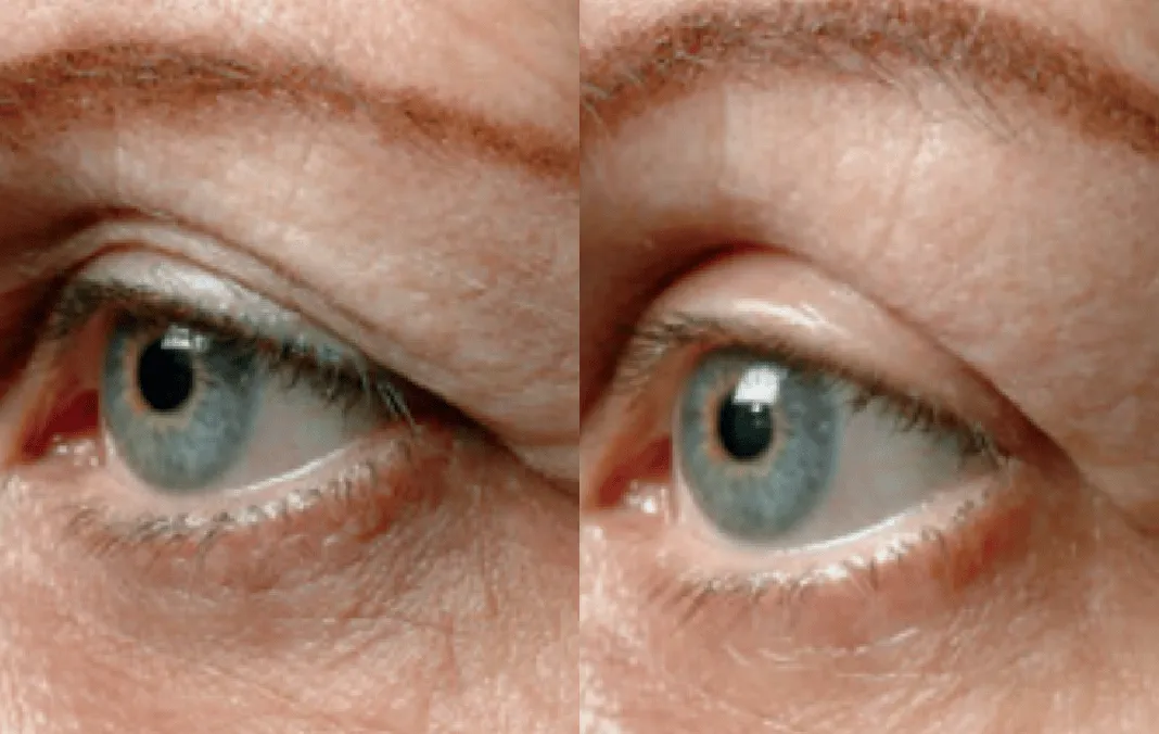 Botox before and after — wrinkles, crow's feet, square jaw — real patient result at Waleerat Clinic Bangkok (Siam & Ekamai)