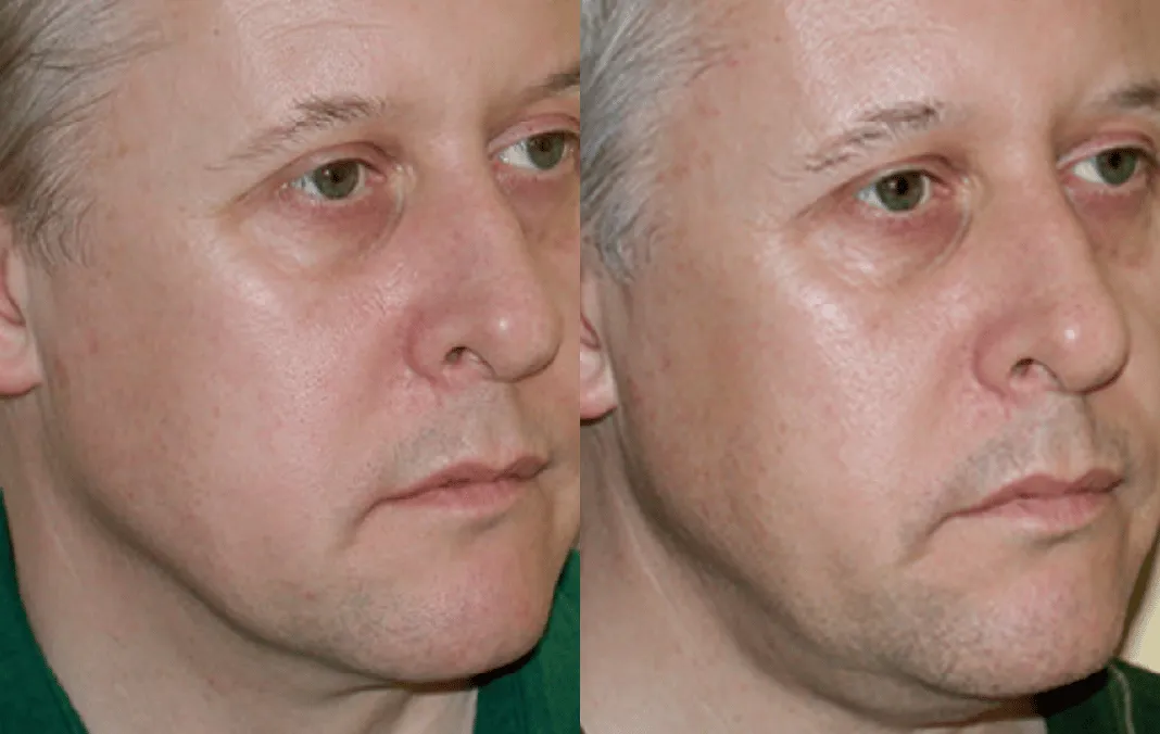 Botox before and after — wrinkles, crow's feet, square jaw — real patient result at Waleerat Clinic Bangkok (Siam & Ekamai)