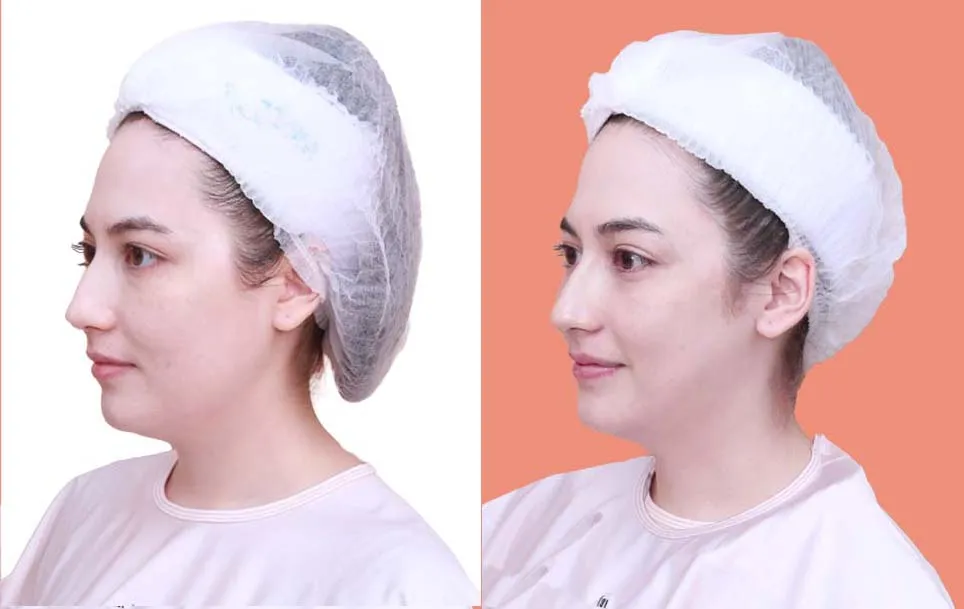 Botox before and after — wrinkles, crow's feet, square jaw — real patient result at Waleerat Clinic Bangkok (Siam & Ekamai)