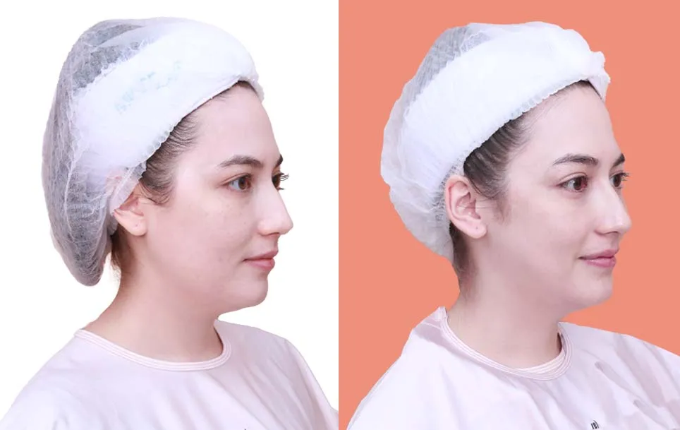 Botox before and after — wrinkles, crow's feet, square jaw — real patient result at Waleerat Clinic Bangkok (Siam & Ekamai)