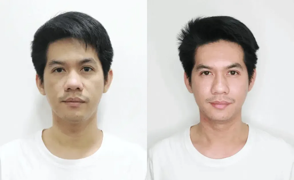 Botox before and after — wrinkles, crow's feet, square jaw — real patient result at Waleerat Clinic Bangkok (Siam & Ekamai)