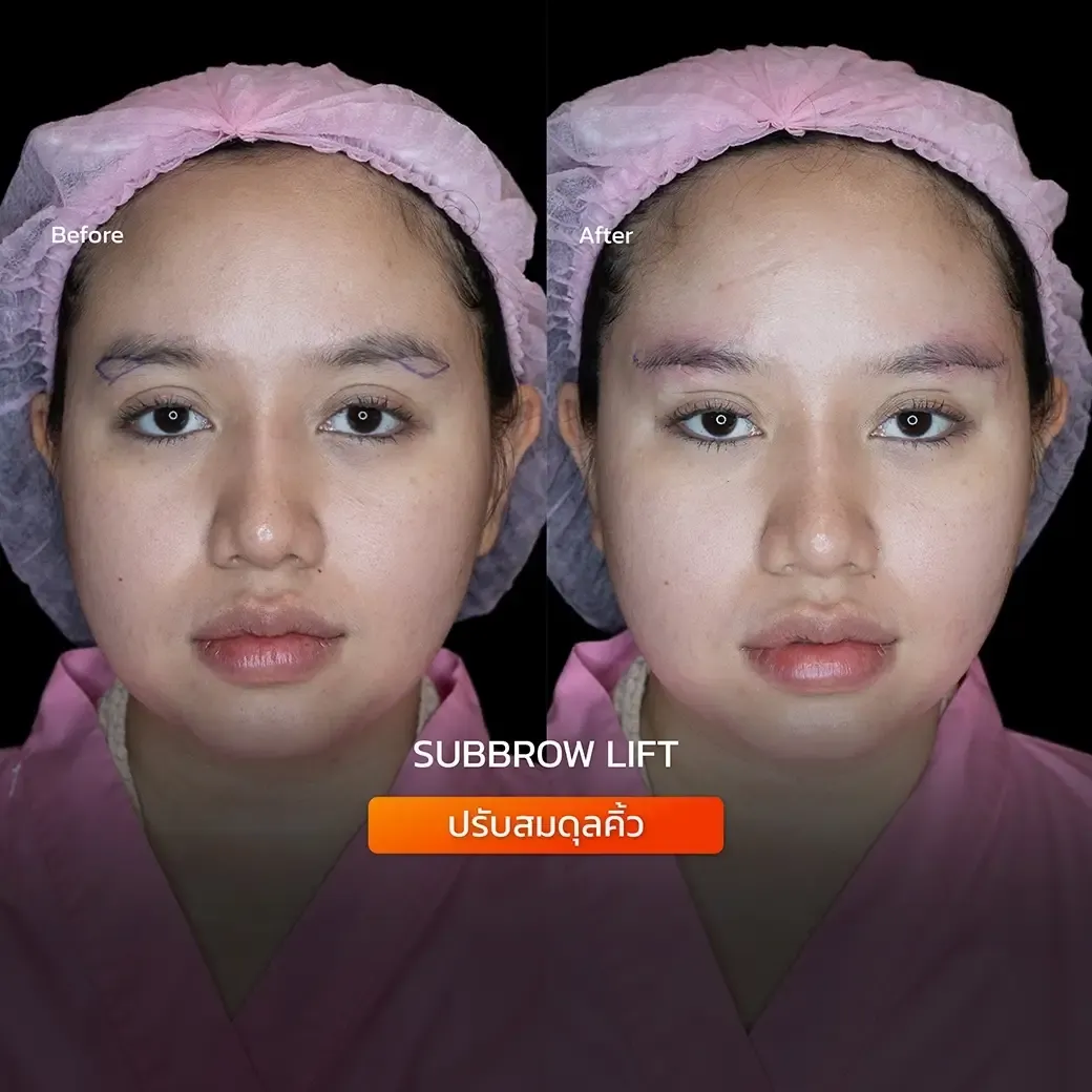 Botox before and after — wrinkles, crow's feet, square jaw — real patient result at Waleerat Clinic Bangkok (Siam & Ekamai)