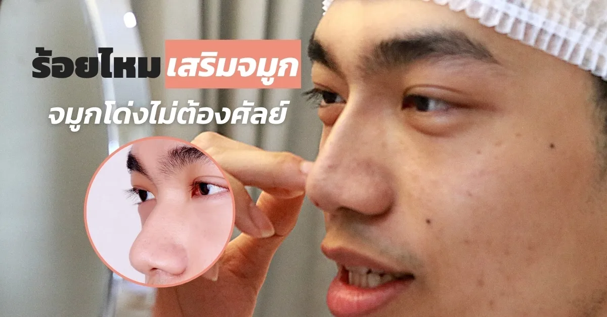 Eye Rejuvenation before and after — under-eye hollows & hooded eyes — real patient result at Waleerat Clinic Bangkok (Siam & Ekamai)