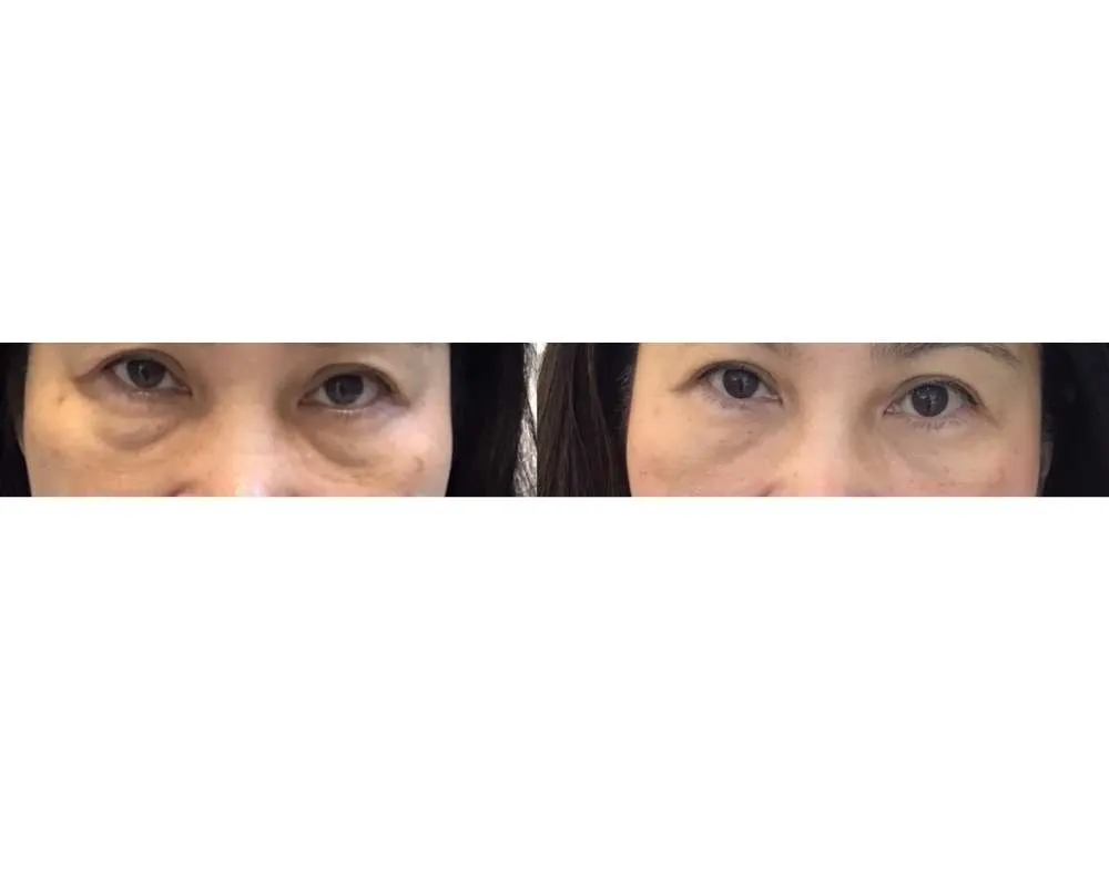 Eye Rejuvenation before and after — under-eye hollows & hooded eyes — real patient result at Waleerat Clinic Bangkok (Siam & Ekamai)