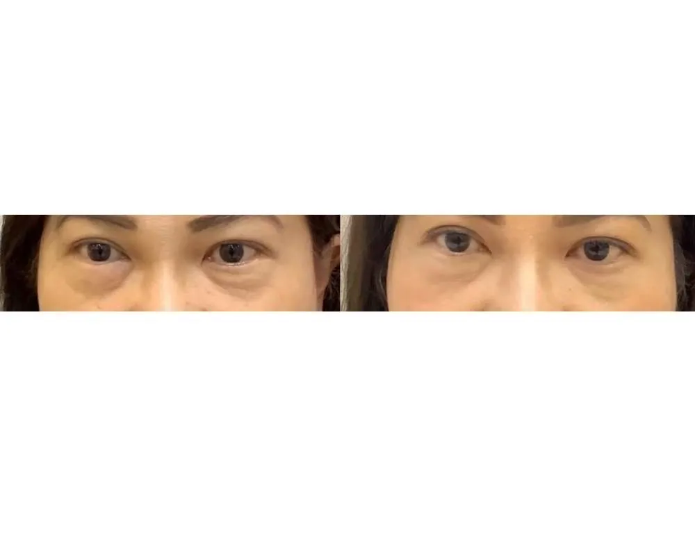 Eye Rejuvenation before and after — under-eye hollows & hooded eyes — real patient result at Waleerat Clinic Bangkok (Siam & Ekamai)