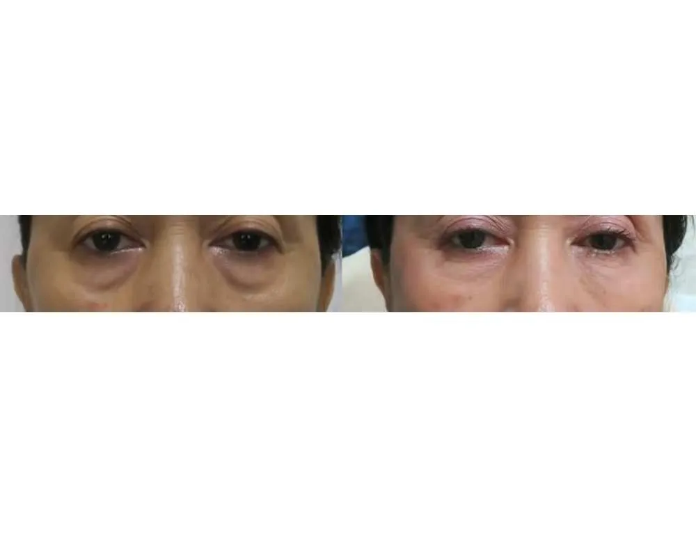 Eye Rejuvenation before and after — under-eye hollows & hooded eyes — real patient result at Waleerat Clinic Bangkok (Siam & Ekamai)