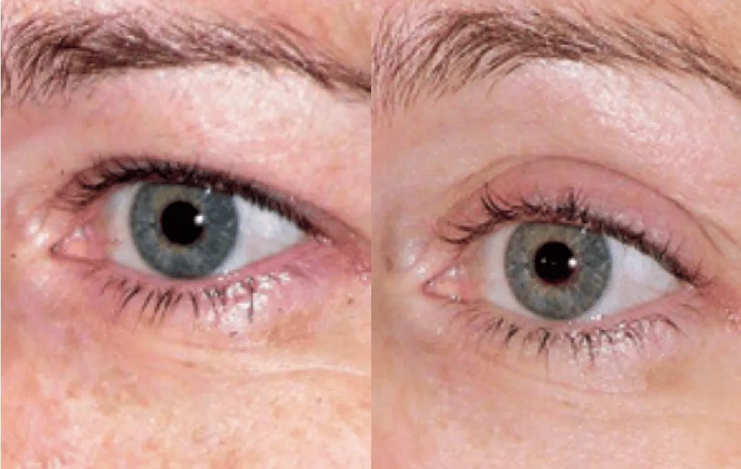 Eye Rejuvenation before and after — under-eye hollows & hooded eyes — real patient result at Waleerat Clinic Bangkok (Siam & Ekamai)
