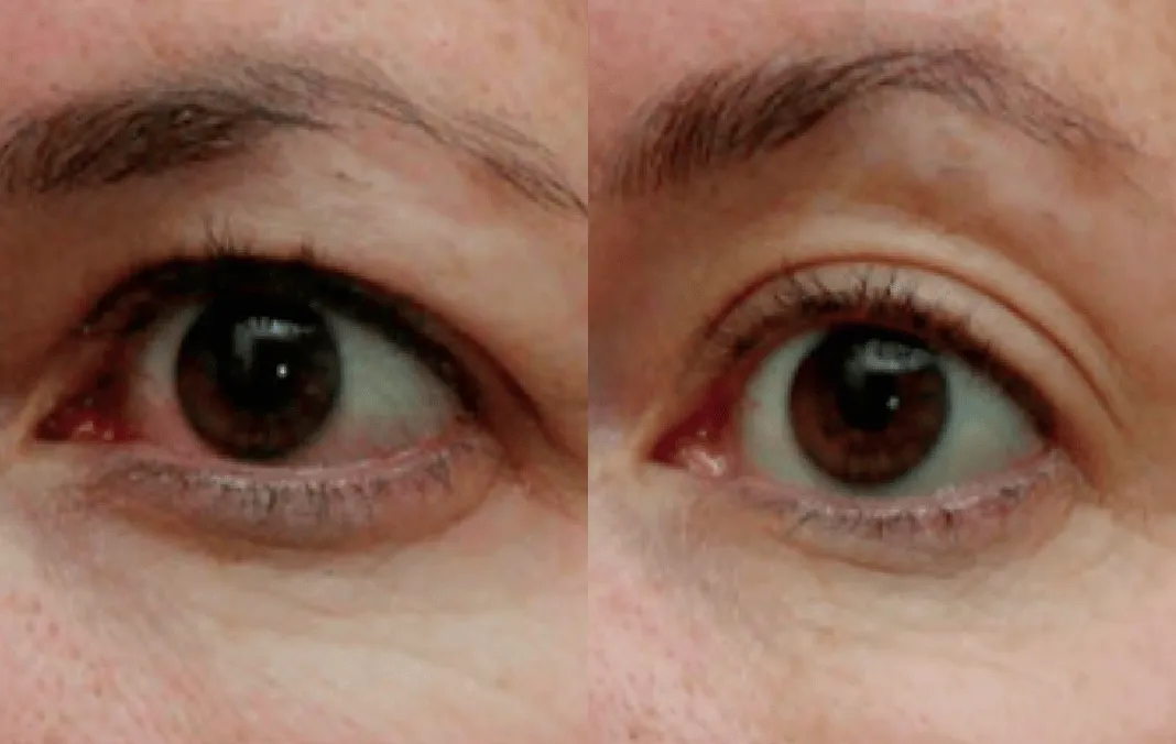 Eye Rejuvenation before and after — under-eye hollows & hooded eyes — real patient result at Waleerat Clinic Bangkok (Siam & Ekamai)