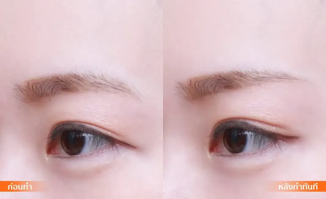 Eye Rejuvenation before and after — under-eye hollows & hooded eyes — real patient result at Waleerat Clinic Bangkok (Siam & Ekamai)