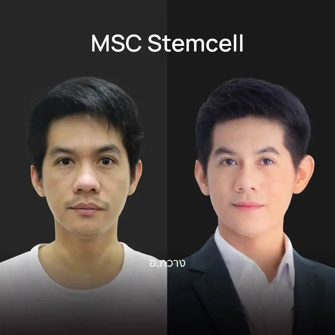 HA Filler before and after — nasolabial folds, tear trough, thin lips — real patient result at Waleerat Clinic Bangkok (Siam & Ekamai)