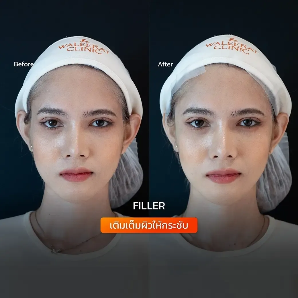 HA Filler before and after — nasolabial folds, tear trough, thin lips — real patient result at Waleerat Clinic Bangkok (Siam & Ekamai)