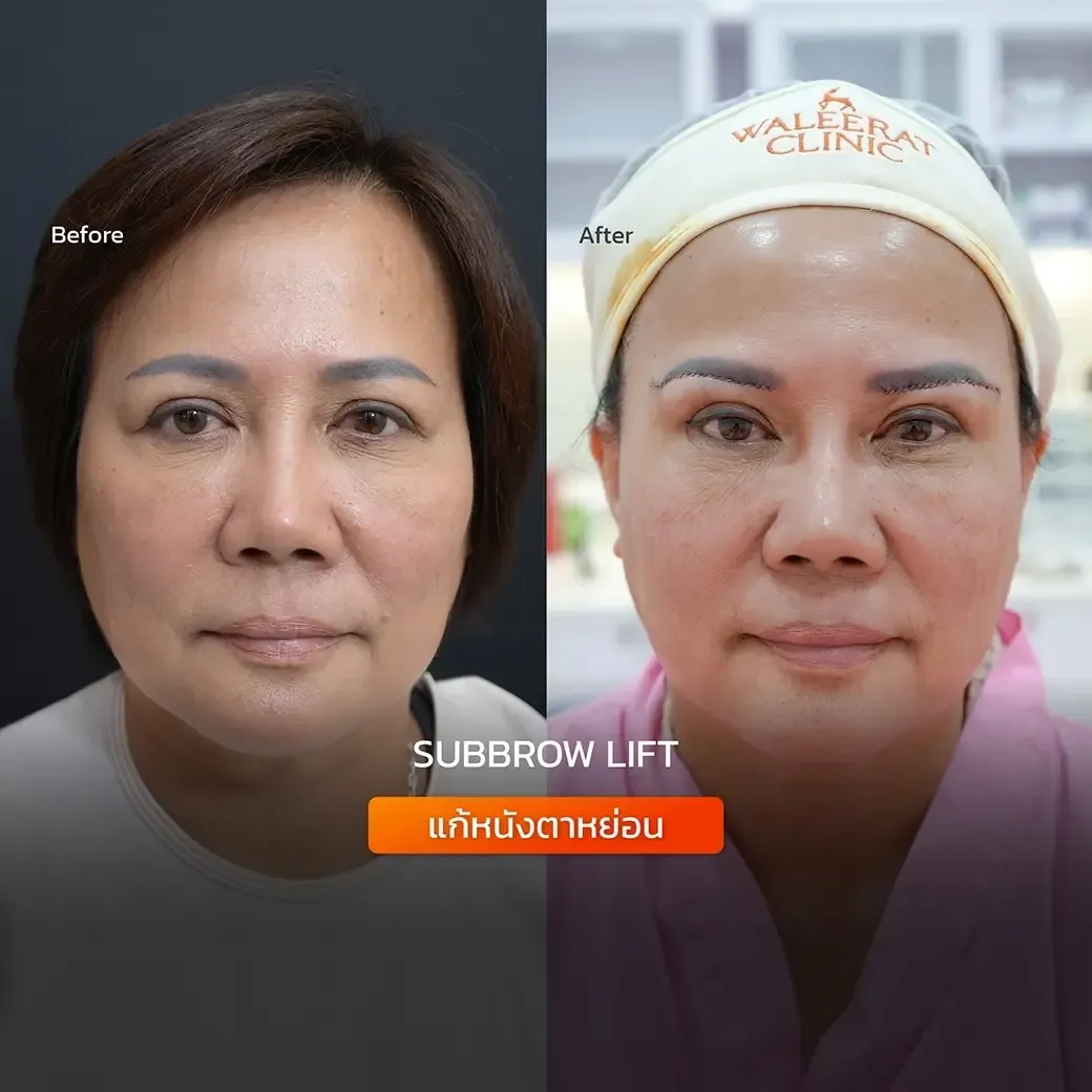 HA Filler before and after — nasolabial folds, tear trough, thin lips — real patient result at Waleerat Clinic Bangkok (Siam & Ekamai)