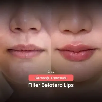 HA Filler before and after — nasolabial folds, tear trough, thin lips — real patient result at Waleerat Clinic Bangkok (Siam & Ekamai)