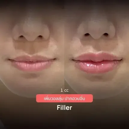 HA Filler before and after — nasolabial folds, tear trough, thin lips — real patient result at Waleerat Clinic Bangkok (Siam & Ekamai)