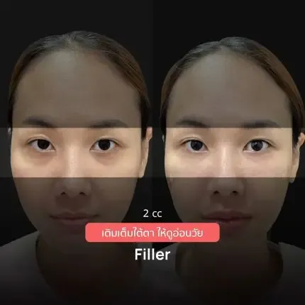 HA Filler before and after — nasolabial folds, tear trough, thin lips — real patient result at Waleerat Clinic Bangkok (Siam & Ekamai)
