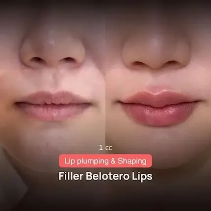 HA Filler before and after — nasolabial folds, tear trough, thin lips — real patient result at Waleerat Clinic Bangkok (Siam & Ekamai)