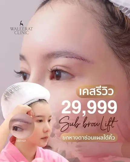 HA Filler before and after — nasolabial folds, tear trough, thin lips — real patient result at Waleerat Clinic Bangkok (Siam & Ekamai)