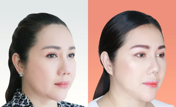 Nose Reshaping before and after — flat bridge & undefined tip — real patient result at Waleerat Clinic Bangkok (Siam & Ekamai)