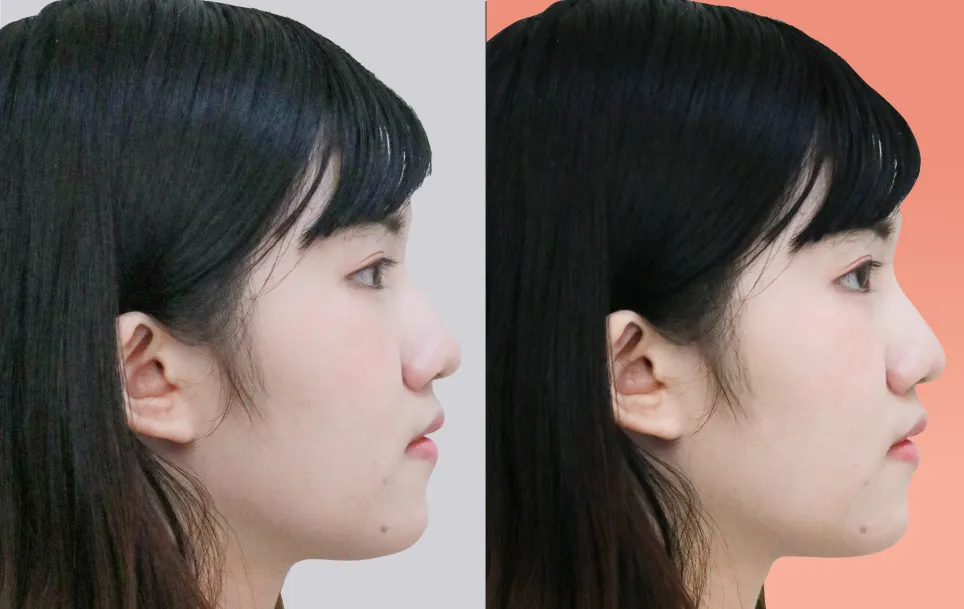 Nose Reshaping before and after — flat bridge & undefined tip — real patient result at Waleerat Clinic Bangkok (Siam & Ekamai)