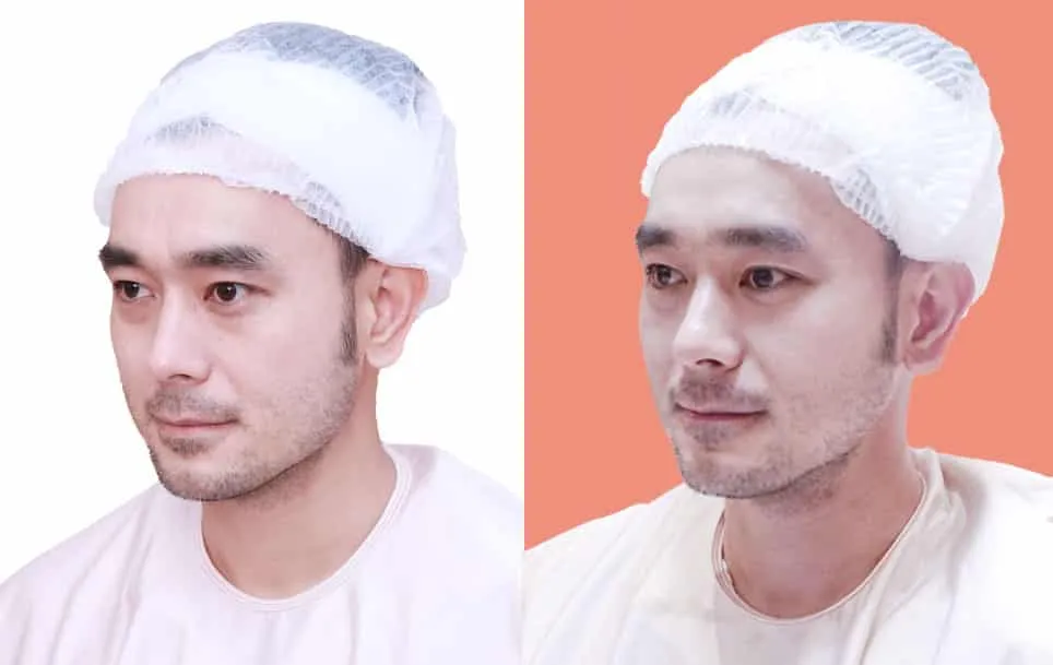 Nose Reshaping before and after — flat bridge & undefined tip — real patient result at Waleerat Clinic Bangkok (Siam & Ekamai)
