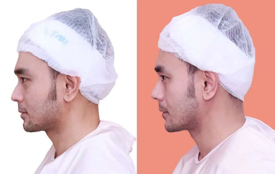 Nose Reshaping before and after — flat bridge & undefined tip — real patient result at Waleerat Clinic Bangkok (Siam & Ekamai)