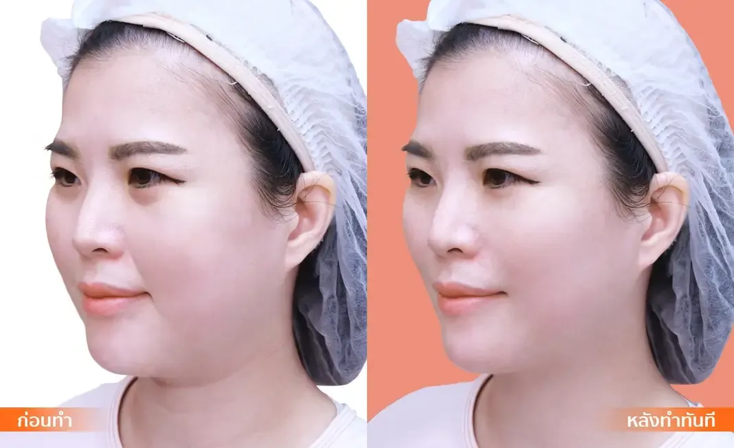 Nose Reshaping before and after — flat bridge & undefined tip — real patient result at Waleerat Clinic Bangkok (Siam & Ekamai)