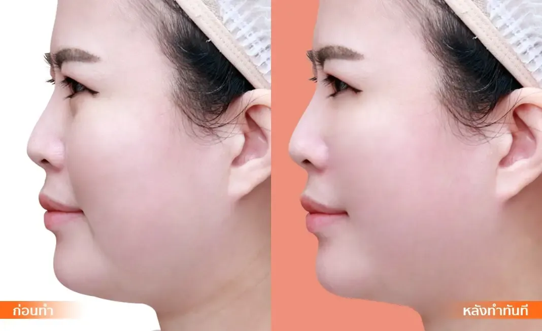 Nose Reshaping before and after — flat bridge & undefined tip — real patient result at Waleerat Clinic Bangkok (Siam & Ekamai)