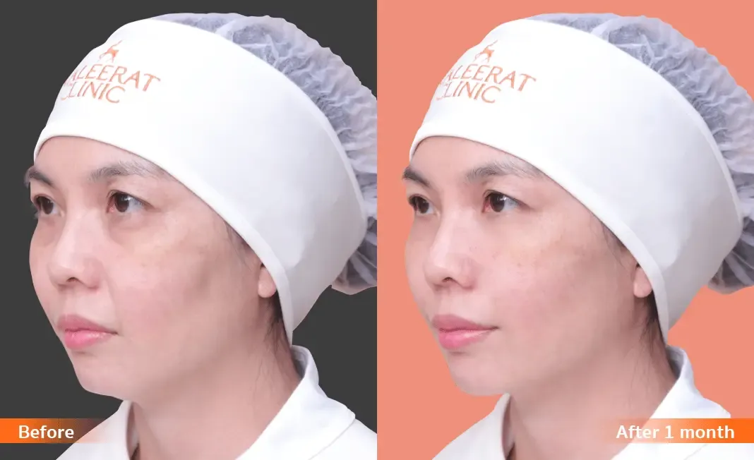 Nose Reshaping before and after — flat bridge & undefined tip — real patient result at Waleerat Clinic Bangkok (Siam & Ekamai)