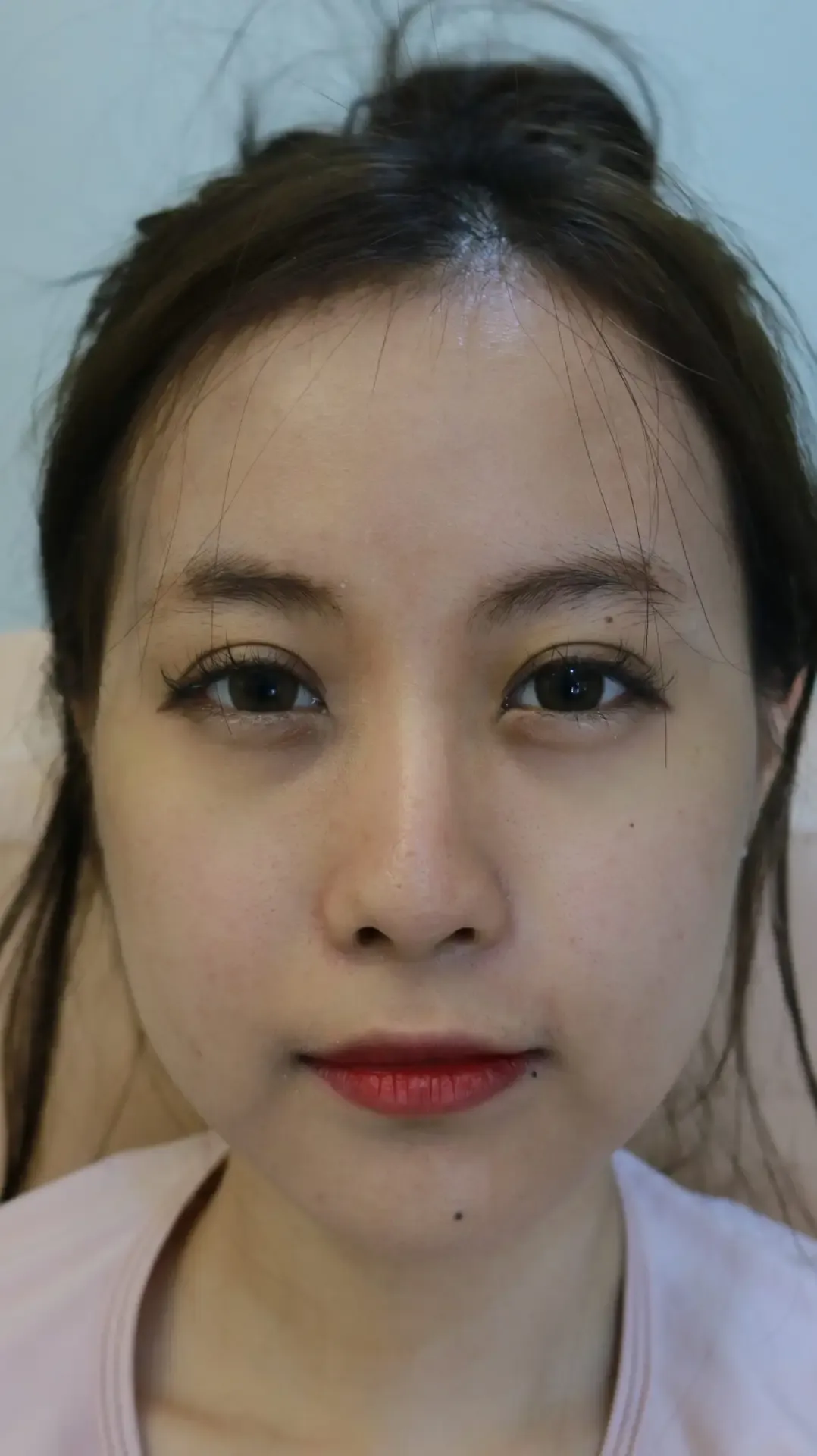 Nose Reshaping before and after — flat bridge & undefined tip — real patient result at Waleerat Clinic Bangkok (Siam & Ekamai)