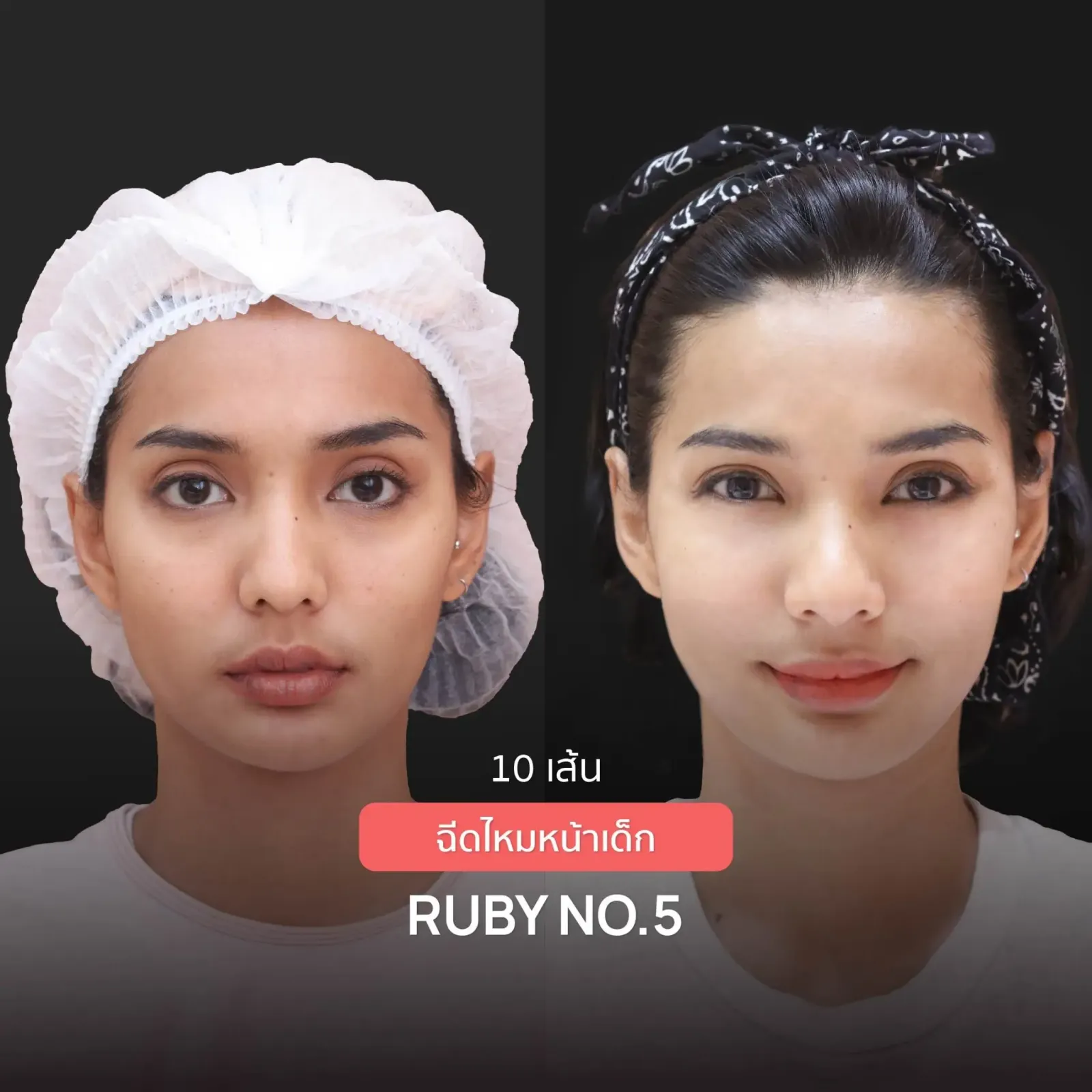 Nose Reshaping before and after — flat bridge & undefined tip — real patient result at Waleerat Clinic Bangkok (Siam & Ekamai)