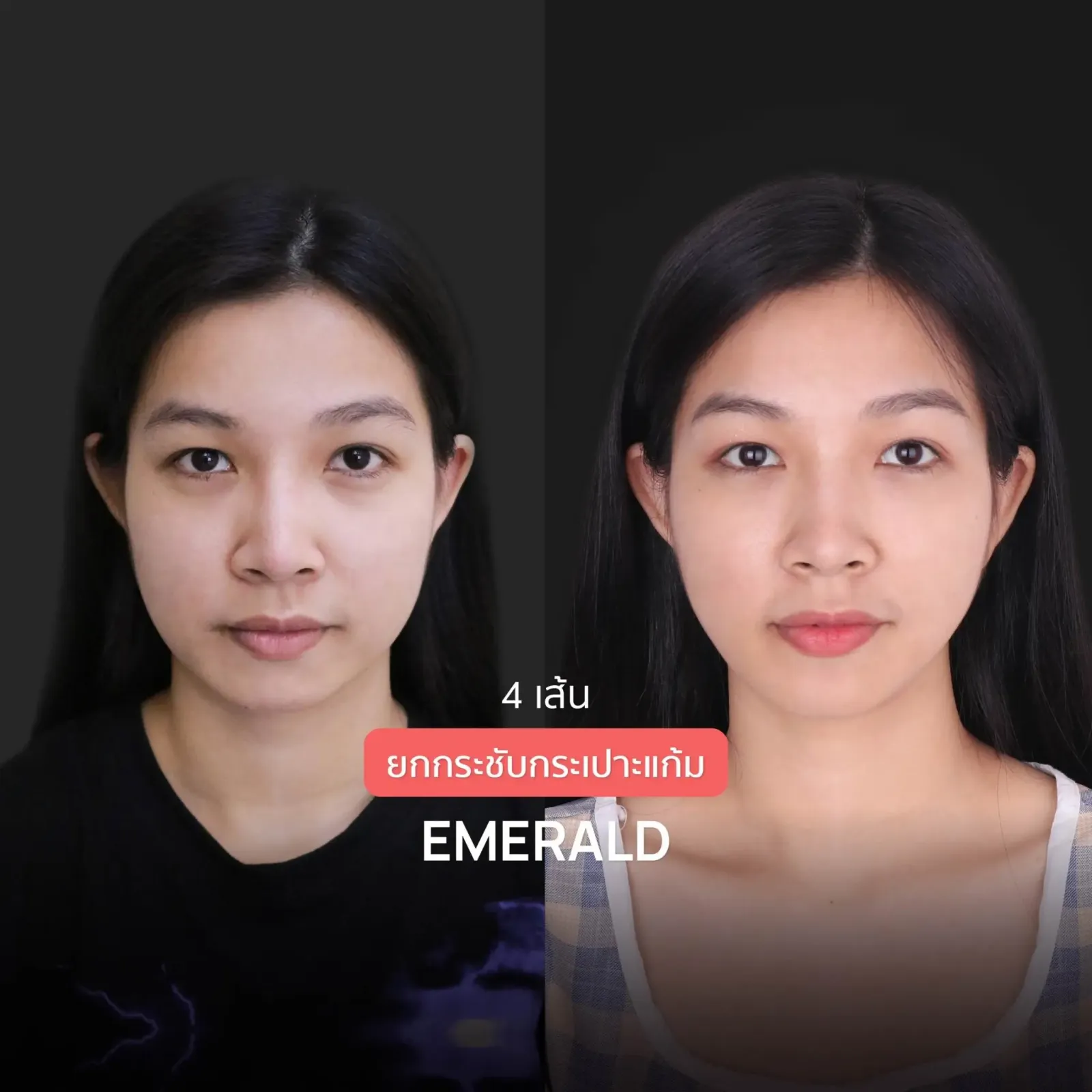 Nose Reshaping before and after — flat bridge & undefined tip — real patient result at Waleerat Clinic Bangkok (Siam & Ekamai)