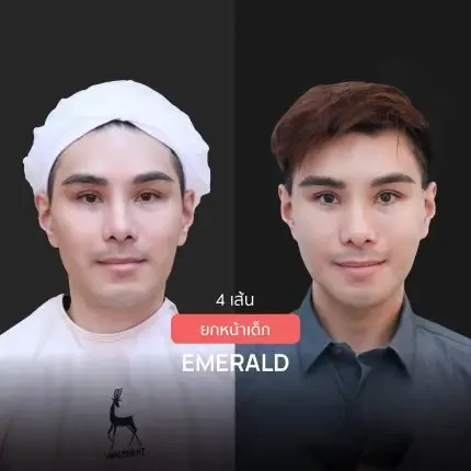 Nose Reshaping before and after — flat bridge & undefined tip — real patient result at Waleerat Clinic Bangkok (Siam & Ekamai)